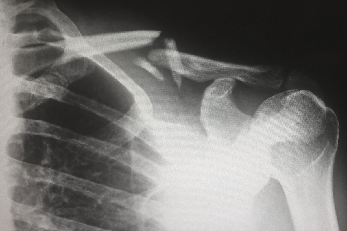 X-ray of a chest, several ribs, shoulder bone