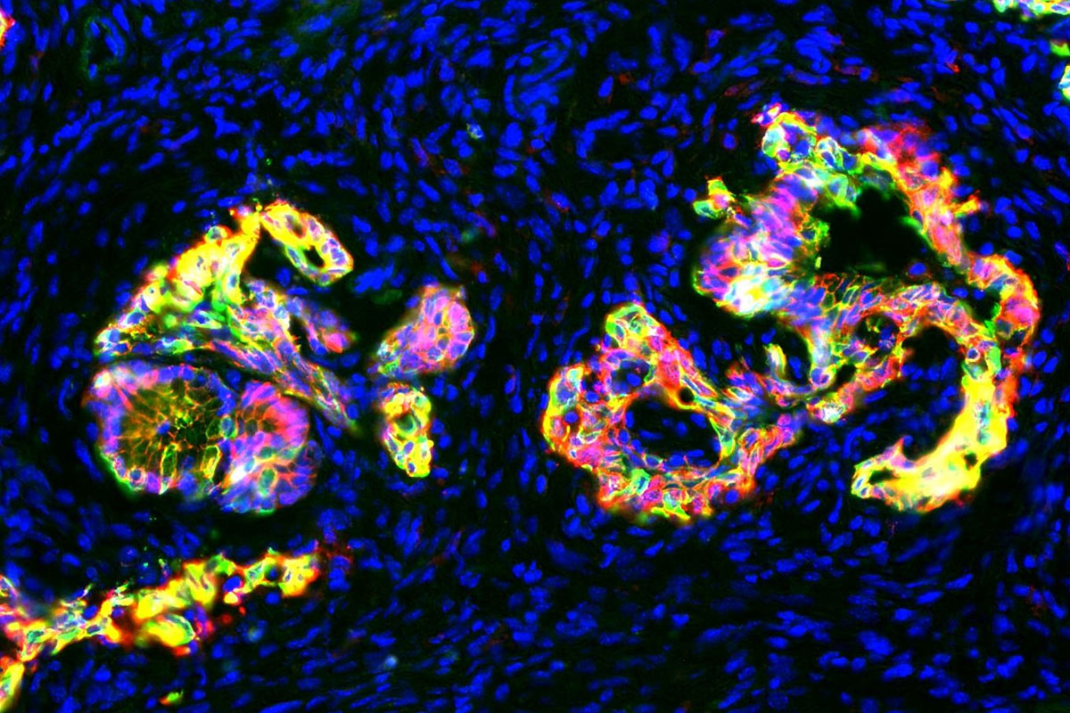 Microscopy image of precancerous pancreatic tissue in mice (cancer)