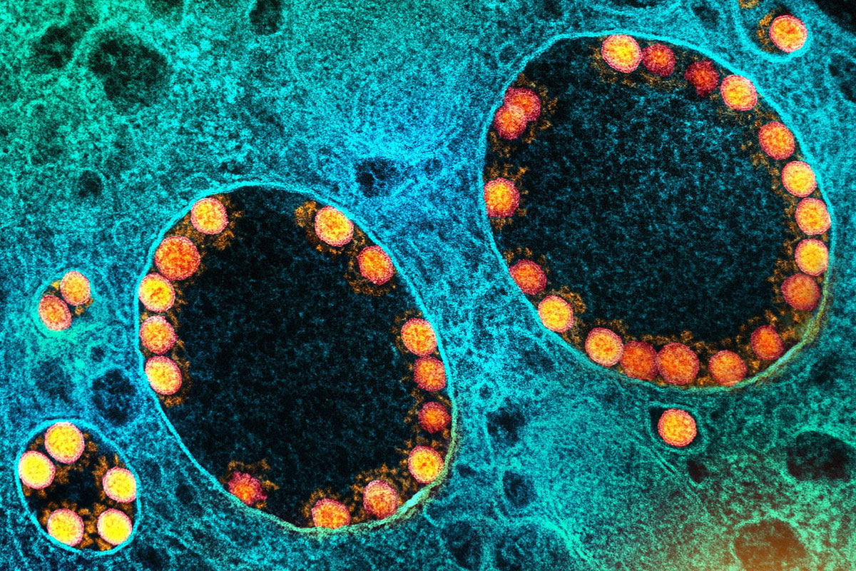 "Microscopy image of SARS-CoV-2 virus particles lining the a few vesicles in a cell (mRNA)