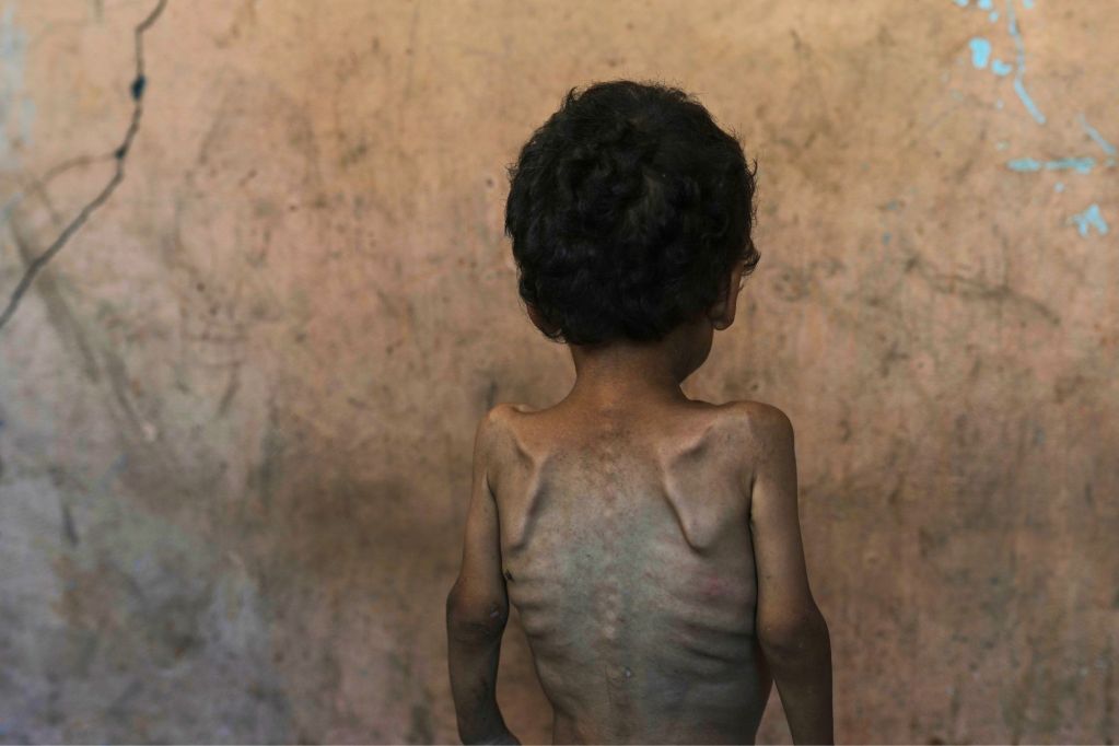 The back of a two year old child, malnourished to the point where all bones are visible