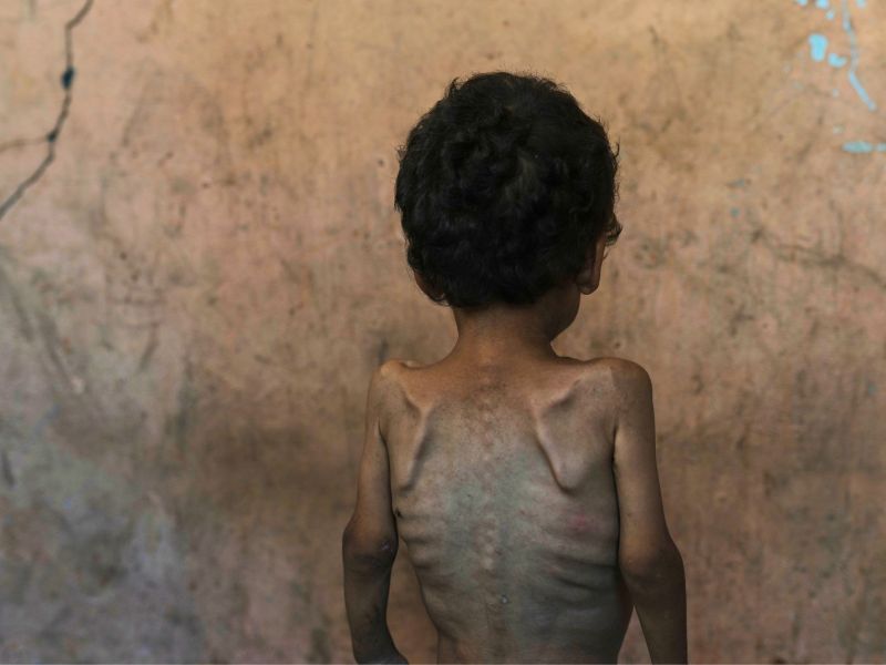 The back of a two year old child, malnourished to the point where all bones are visible