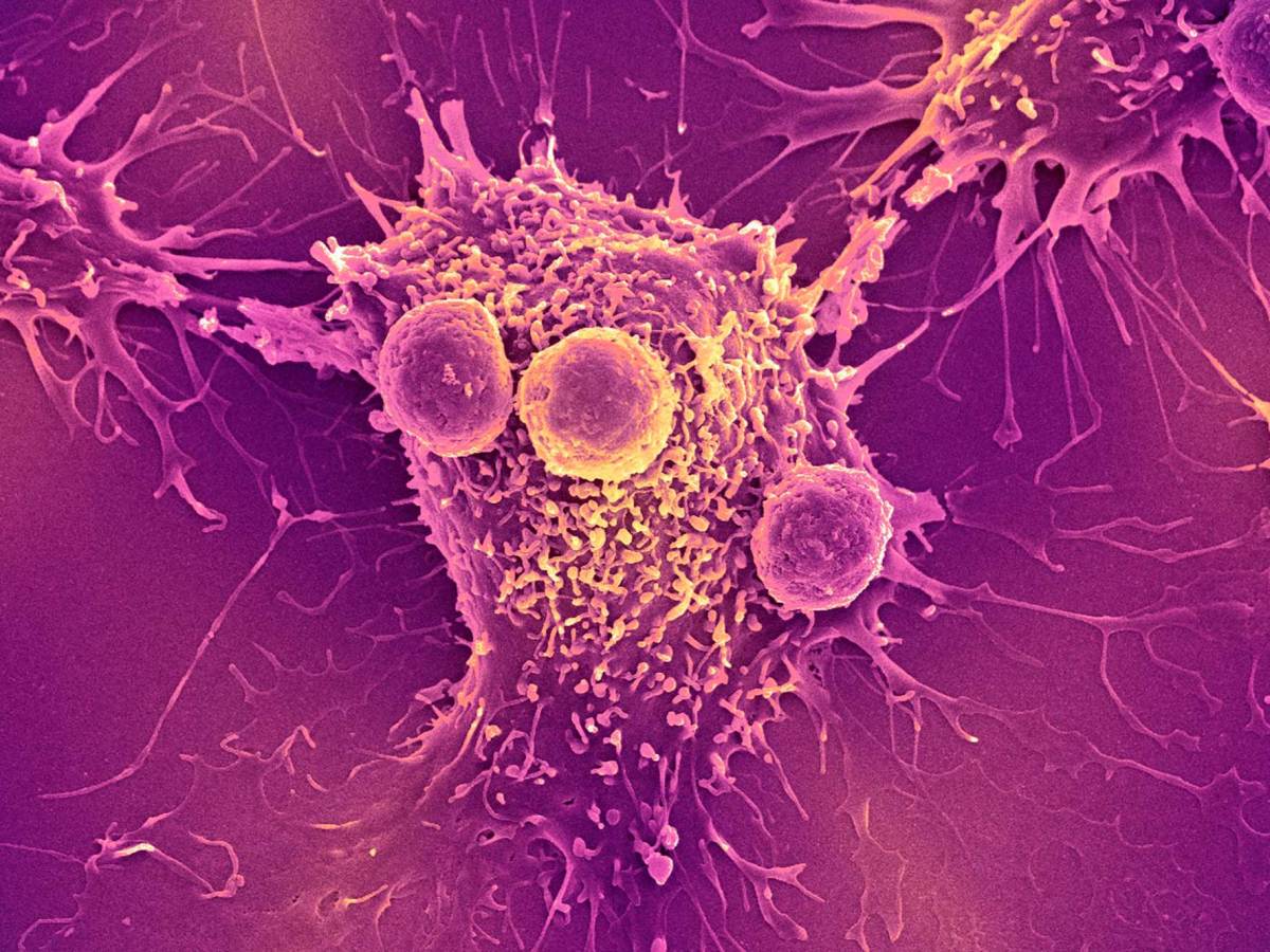 Tumor cells under a microscope in bright purples and yellows